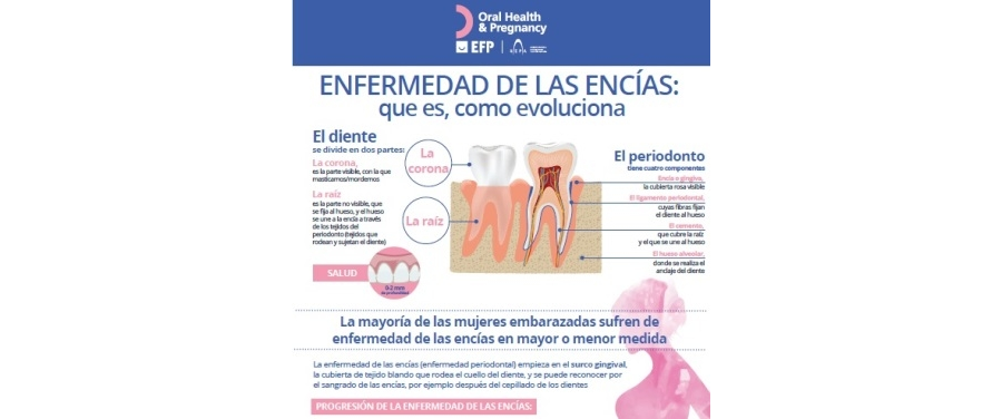 Infografia Enfermedad de las encías mujer